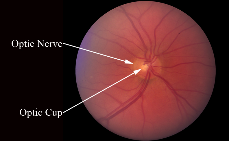 close up of eye highlighting optic nerve and optic cup